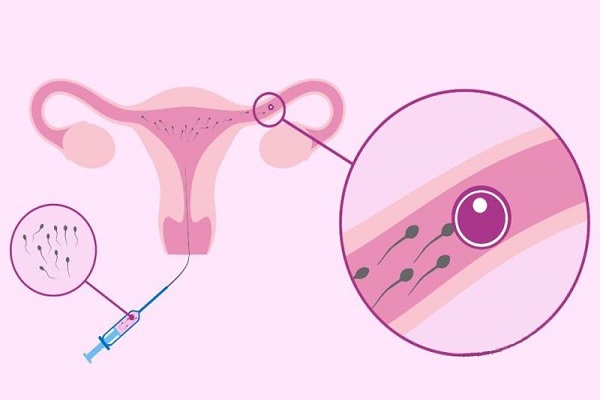 关于供卵试管助孕的三个误区，不要盲目相信