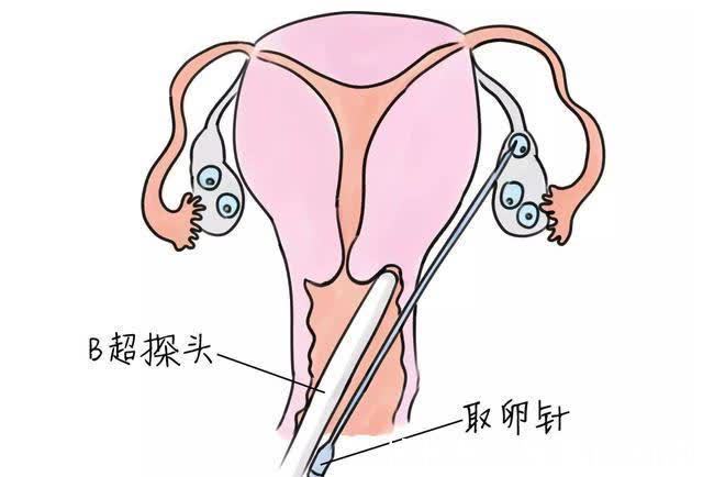 100人中只有一人成功？42岁时供卵助孕自怀试管的实际成功率